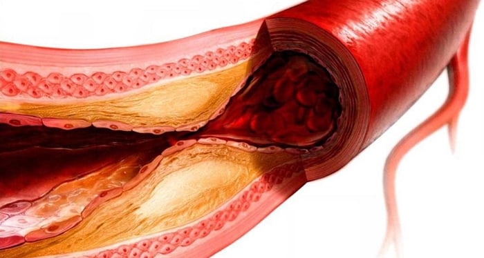 Призыв к чисткe сосудов